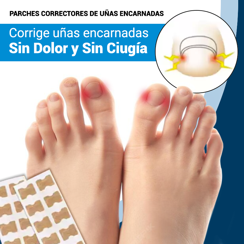Corrige uñas encarnadas sin dolor y sin cirugía