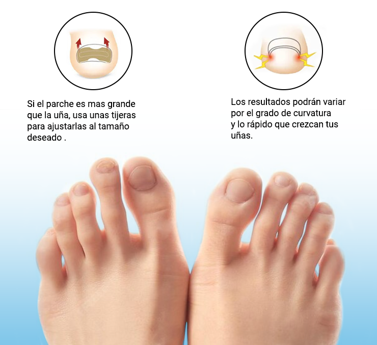Corrige uñas encarnadas sin dolor y sin cirugía
