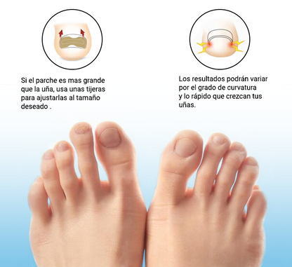 Corrige uñas encarnadas sin dolor y sin cirugía