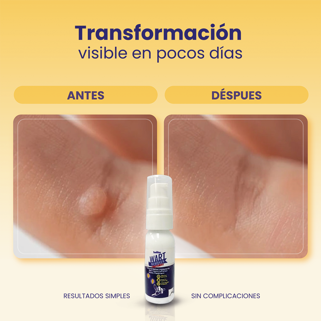 Wart Remover -  Removedor de verrugas