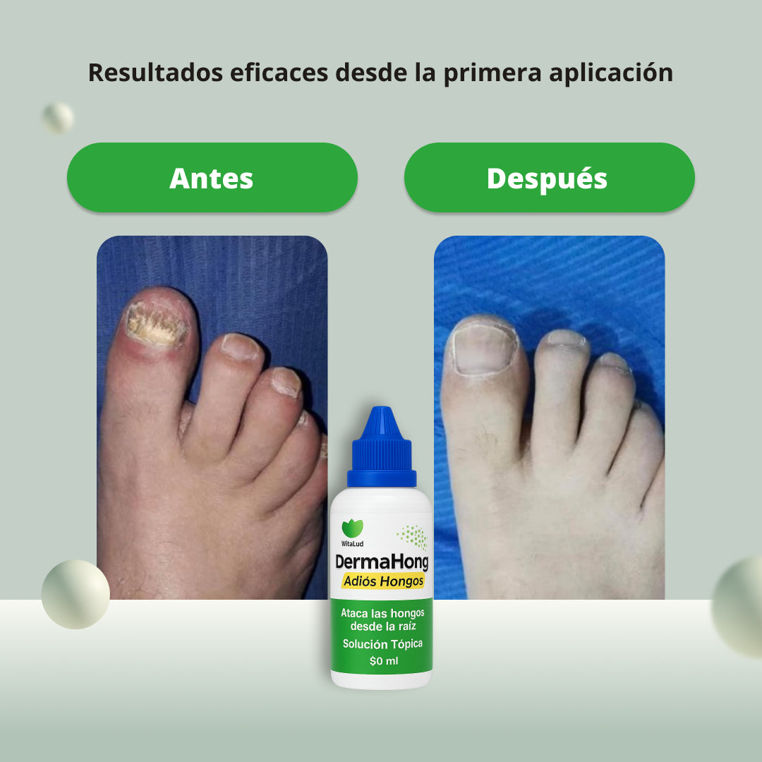DermaHong™ | La solución definitiva para el hongo