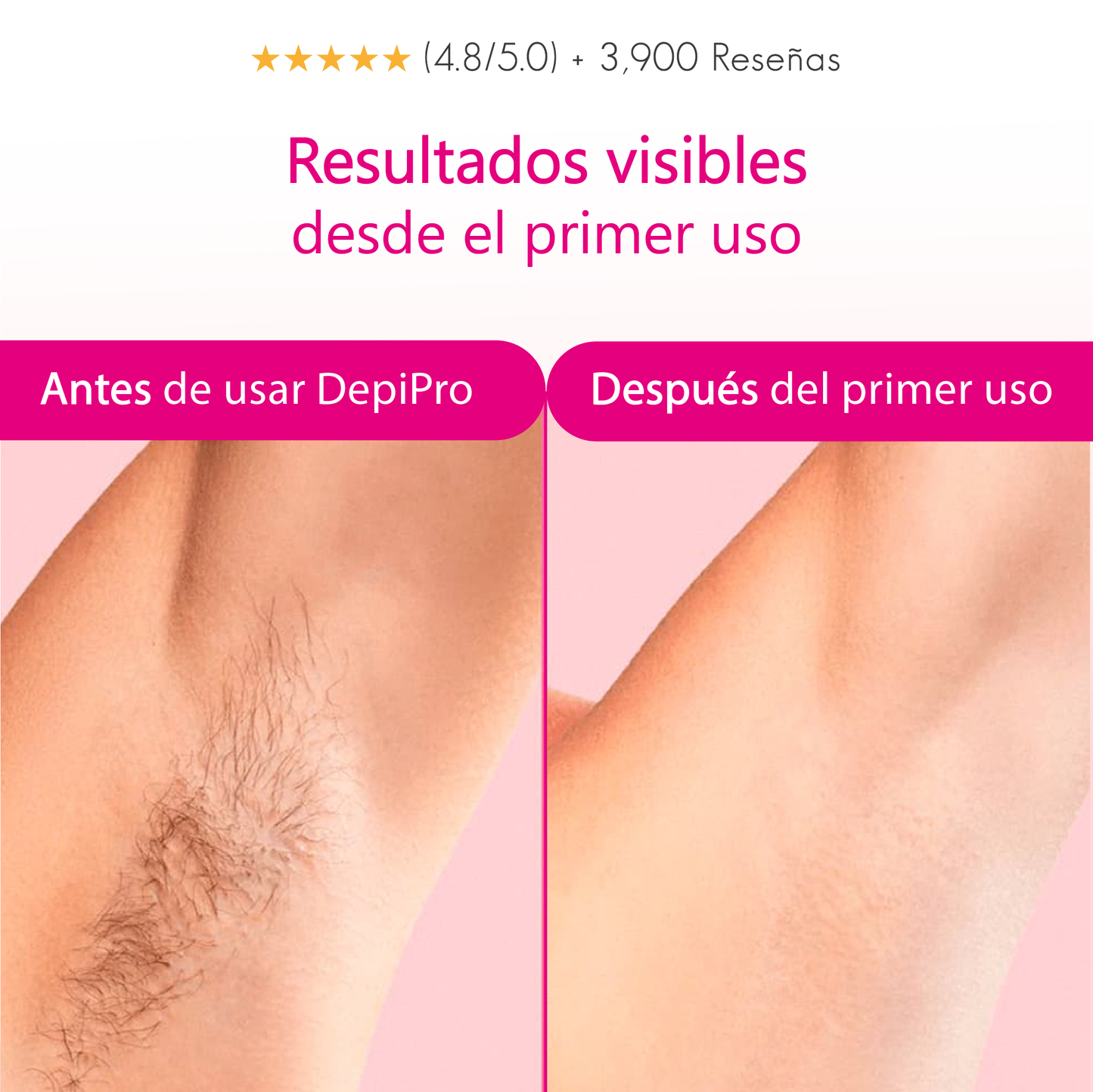 Depilación Profesional en Casa (IPL/DepiPro).