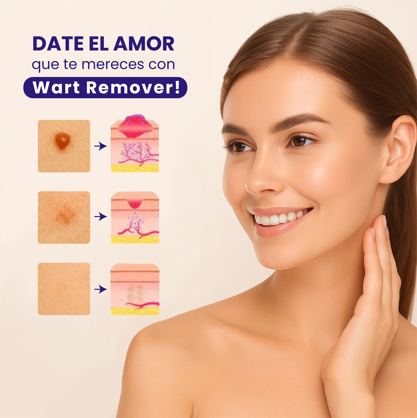Wart Remover -  Removedor de verrugas