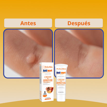 PerfectSkin® | Crema Eliminadora de Verrugas